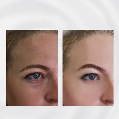 RadiantRoll - Stalowe Narzędzie do Ujędrniania Skóry