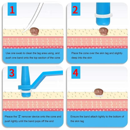 Zestaw do usuwania brodawek skórnych - 2-w-1 System ligacji silikonowej do bezpiecznego użytku w domu
